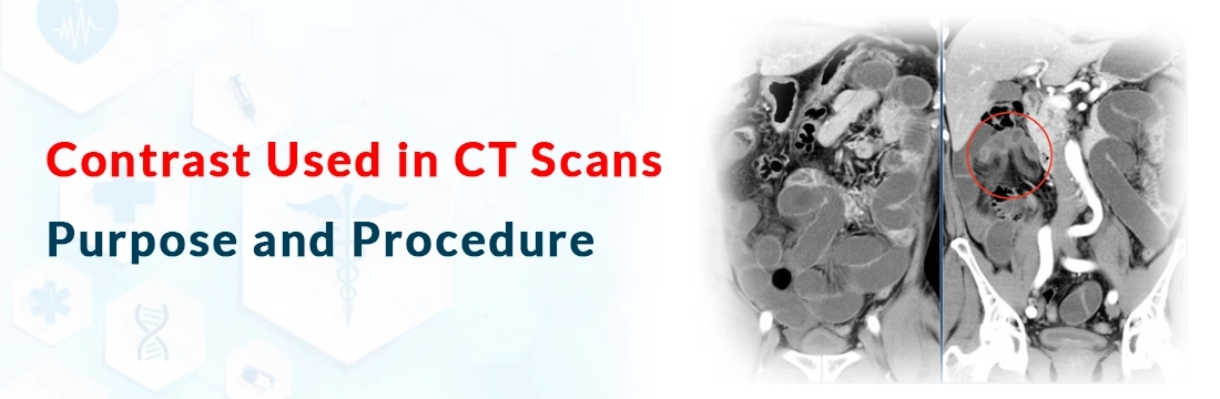 Contrast Used in CT Scans: Purpose and Procedure